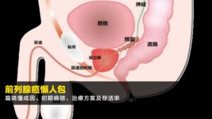 【2026前列腺癌懶人包】一篇搞懂成因、初期病徵、治療方案及存活率