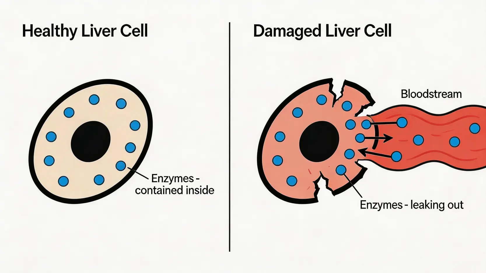 肝酵素高點算好?2026終極指南:一篇搞懂肝酵素高原因、症狀及降肝酵素食物 2 肝酵素高,肝酵素高原因,降肝酵素食物,肝功能指數過高 健康與受損肝細胞對比圖,顯示受損細胞如何將肝酵素釋放到血液中。