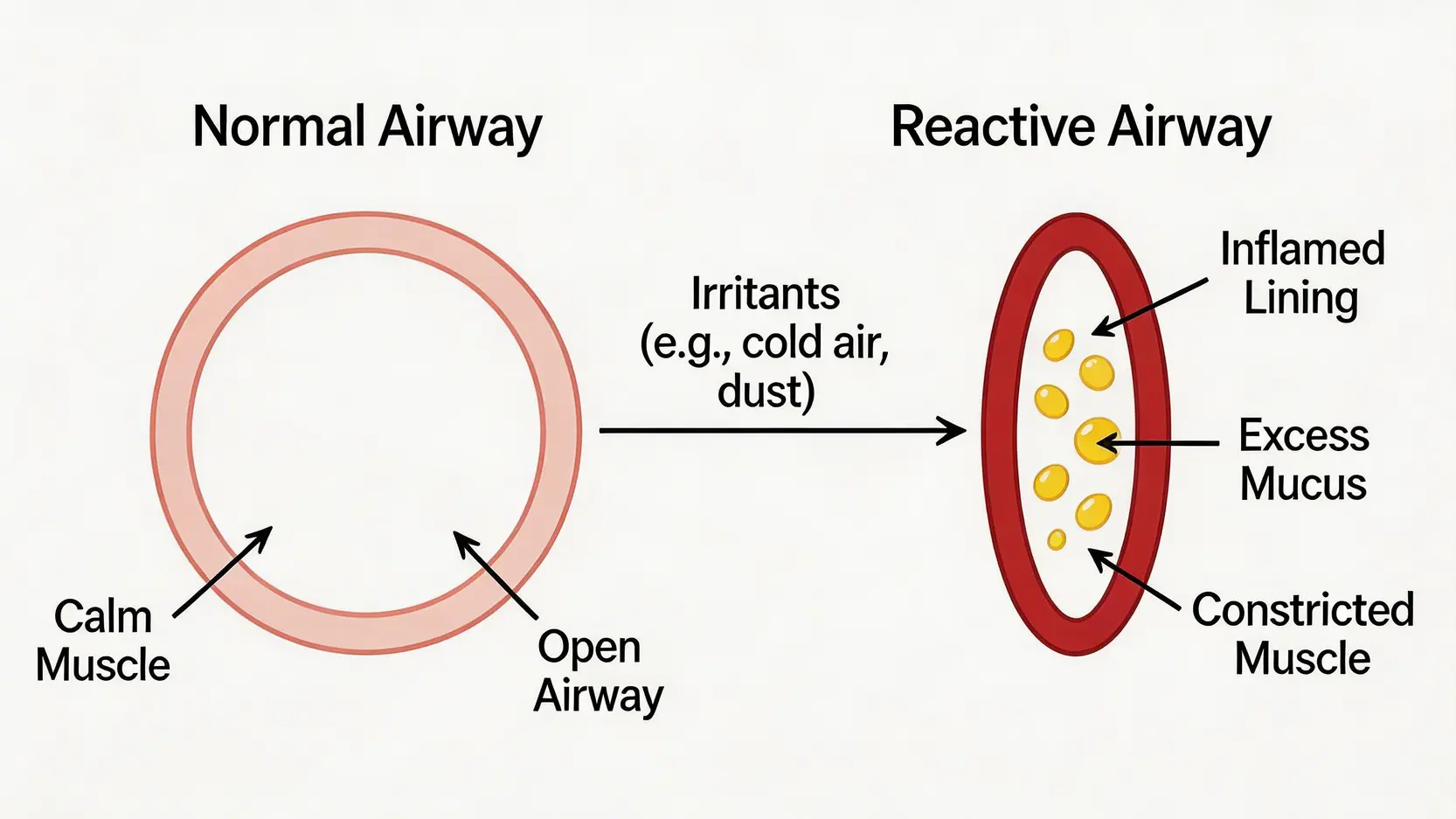 氣管敏感全攻略:咳唔停?即學5款食療湯水、了解成因與斷尾方法 2 氣管敏感,氣管敏感咳,氣管敏感斷尾,氣管敏感食療 正常氣管與敏感氣管的橫切面對比圖,展示敏感氣管在受刺激後如何發炎、收縮和分泌黏液導致氣道收窄。